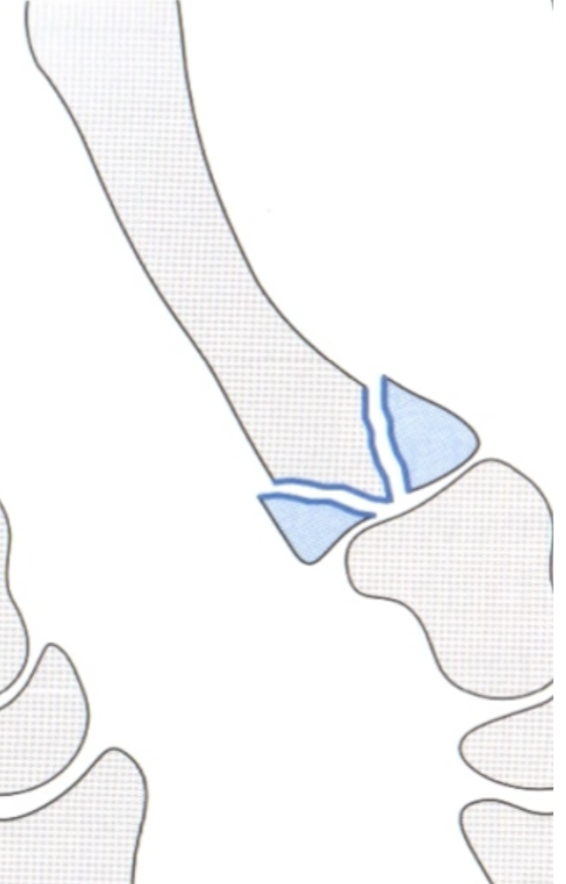 <p>Y shaped or comminuted # of metacarpal base</p>