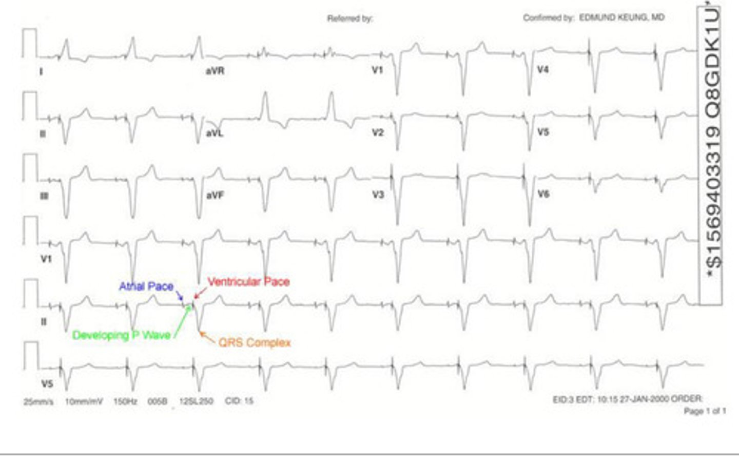 <p>this is an example of a ____ _____ pacemaker</p>