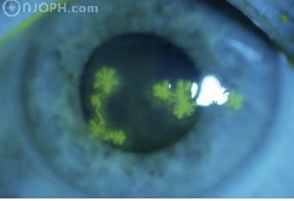 <p><span>Par quoi devrait être traitée cette entité ?</span></p><p></p><p><span>A. Antibiotiques</span></p><p><span>B. Antiviraux</span></p><p><span>C. Anti-fongiques</span></p><p><span>D. Corticostéroïdes aux heures</span></p><p><span>E. Larmes artificielles</span></p>