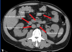 <p>radiation is projectd through the body at multiple angles to produce a 3D image</p><p>- use of contrast dyes to enhace visibility of vessels</p><p>- diagnose abdominal, vertebral column, and brain injuries</p>