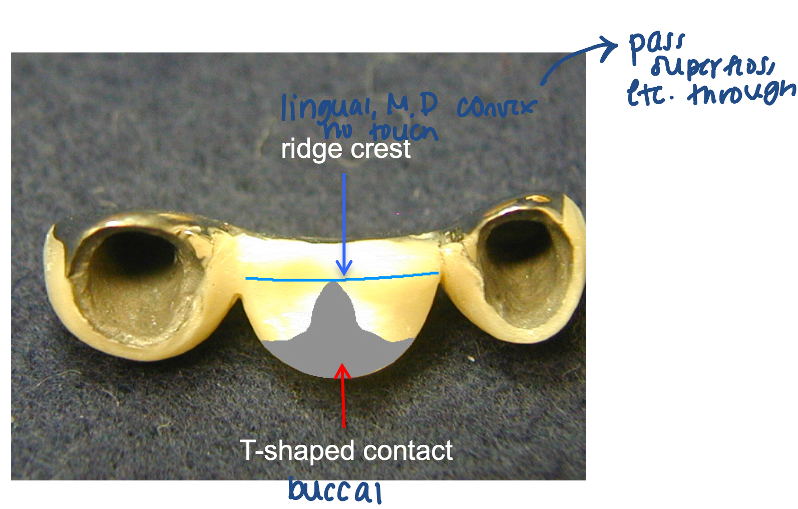 <p>buccal has T shaped contact</p>