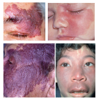 <p>What is the most likely diagnosis ?</p>