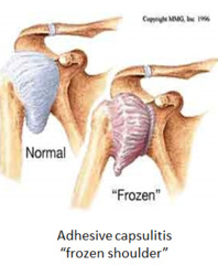 <p>extreme stiffness of the shoulder joint (a.k.a. frozen shoulder)</p>
