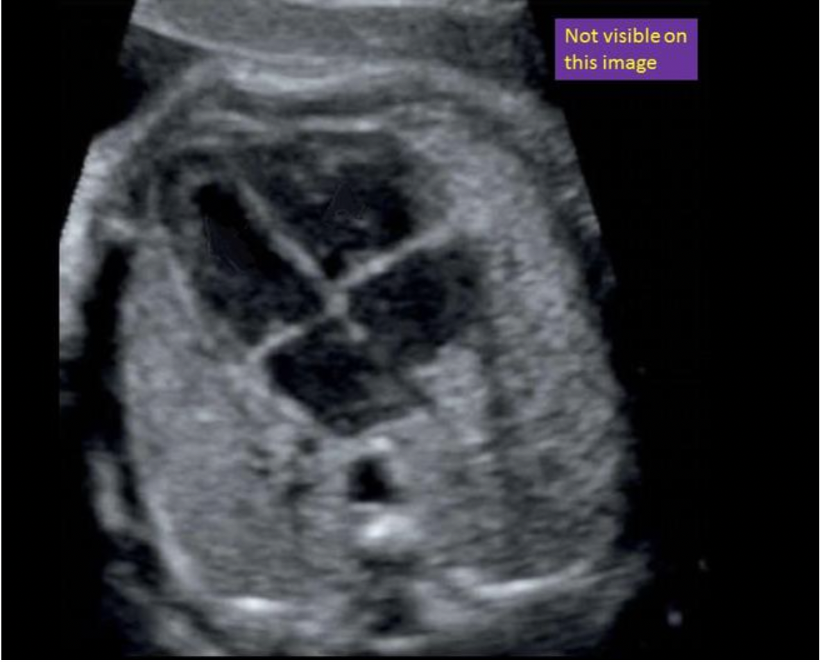<p>Locate the descending aorta. The structure may or may not be visible in the image</p>