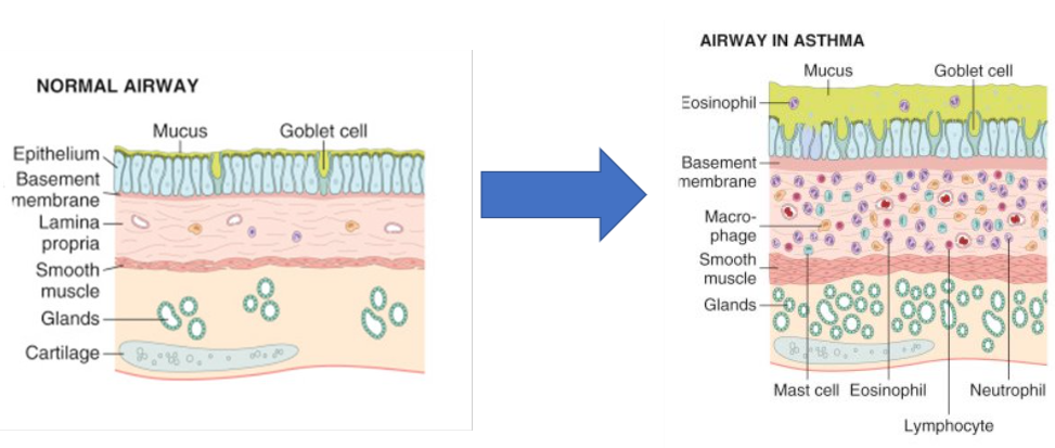 <p>goblet cells (mucus)</p><p>eosinophils/macrophage/mast cells > edema/inflam</p><p>smooth muscle hypertrophy</p>