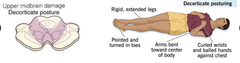 <p>What does decorticate posturing indicate anatomically?</p>
