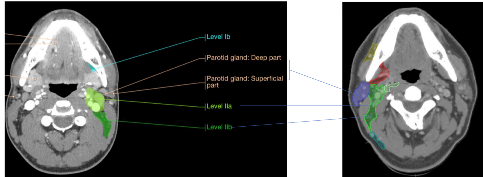 <p>what is the sup and inf border of level II - upper jugular group</p>