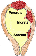<p>deep penetration of myometrium</p>