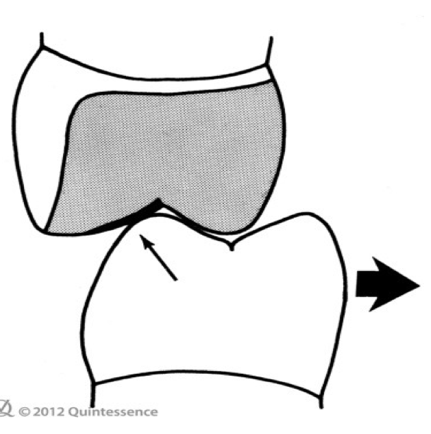 <p>A premature contact (small arrow) on the palatal slope of the maxillary buccal cusp produces a _______ shift (large arrow) of the mandible</p>