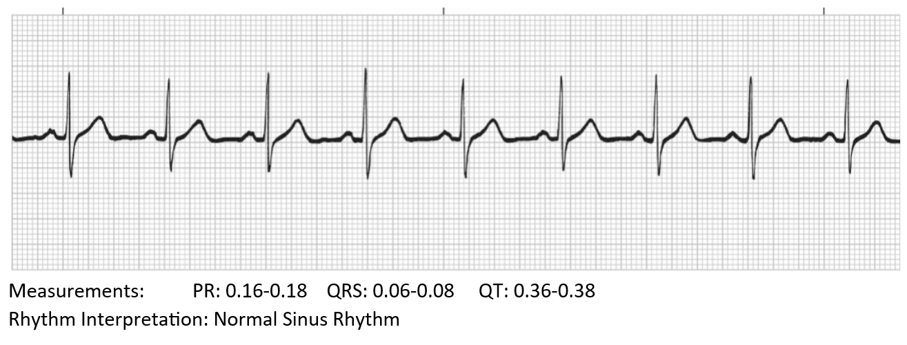 <p>Normal Sinus Rhythm</p>