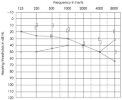 <p>•Hearing loss is described as gradual with associated tinnitus, sometimes balance issues</p><p>•Audiogram - will show a mixed hearing loss with a "carhart notch" at 2000 khz</p>