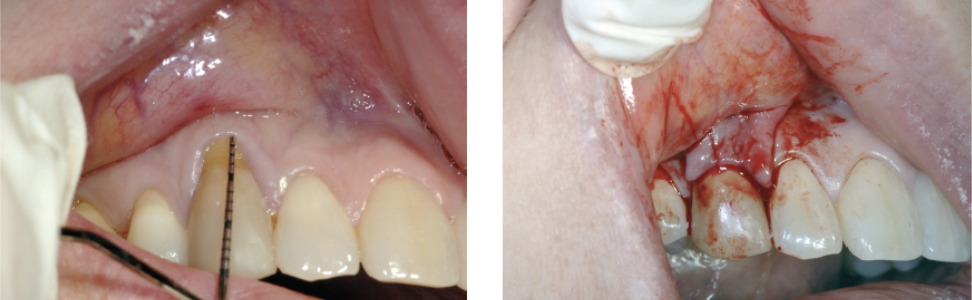 <p><span>Displaced Flap with a Photo:</span></p>