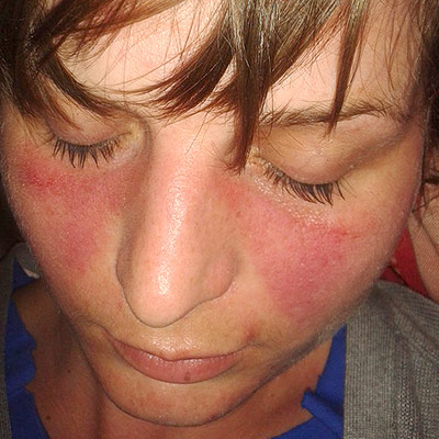 <p>What are the characteristic findings of lupus?</p>