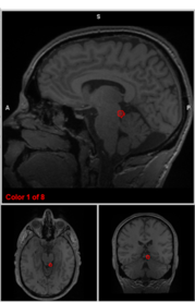 <p>right inferior colliculus</p>