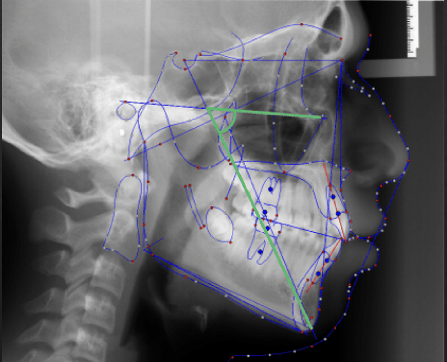 <p>What skeletal measurement:</p><p>- Frankfort Horizontal vs. Sella-Gnathion</p><p>- Vertical relationship between the cranial base and the mandible</p><p>- Tells you about the vertical angulation of the mandible</p>