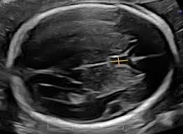 <p>Box shaped midline brain structure between frontal horns of lateral ventricles</p>