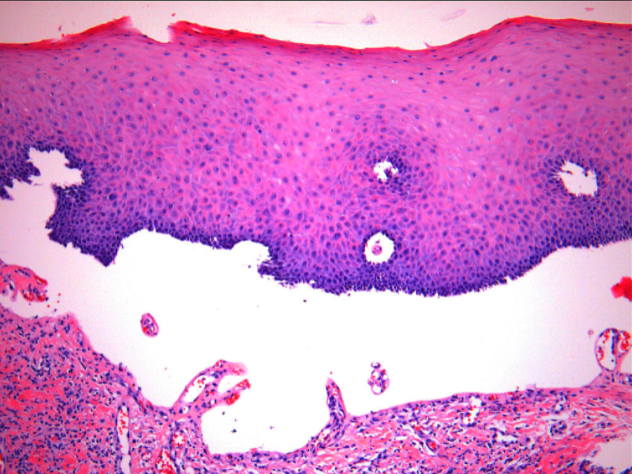<p>Histopathologic Features of what condition?</p><p>• Sub-epithelial separation below basal layer (SUB-basilar cleavage)</p><p>• Mimics linear IgA disease, epidermolysis bullosa acquisita, and angina bullosa hemorrhagica</p>