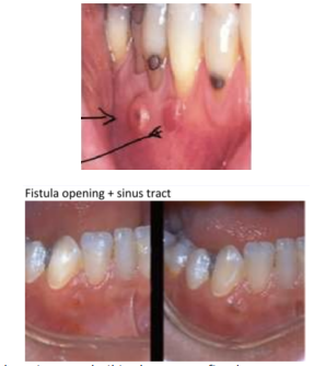 <p>Other term is PARULIS</p><p>Accumulation of pus in the gingival tissue. May be periodontal or pulpal</p>