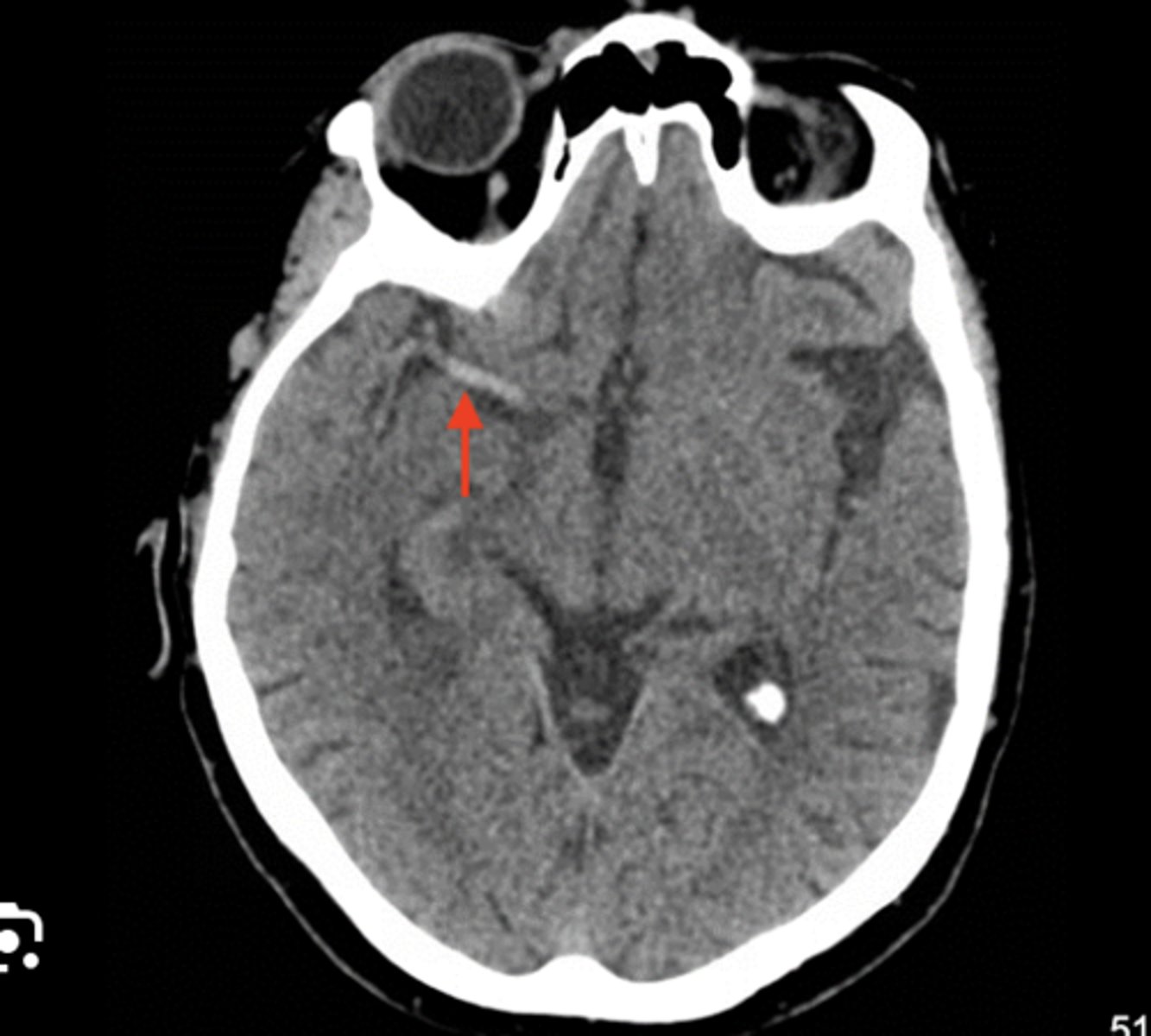 <p>warning sign of stroke on CT</p><p>dense = bright</p><p>indicative of clot in the middle cerebral artery</p>