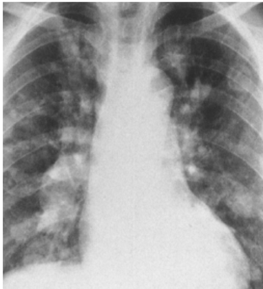 <p>Rupture into pleural cavity associated w/ pneumothorax, pleural effusion, and empyema caused by Echinococcus granulosus.  </p>