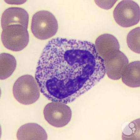 <ul><li><p>Large, deep purple primary granules in the neutrophil cytoplasm</p></li><li><p>Formed when the neutrophil releases its secondary granules, making the primary ones more visible</p></li></ul><p></p>