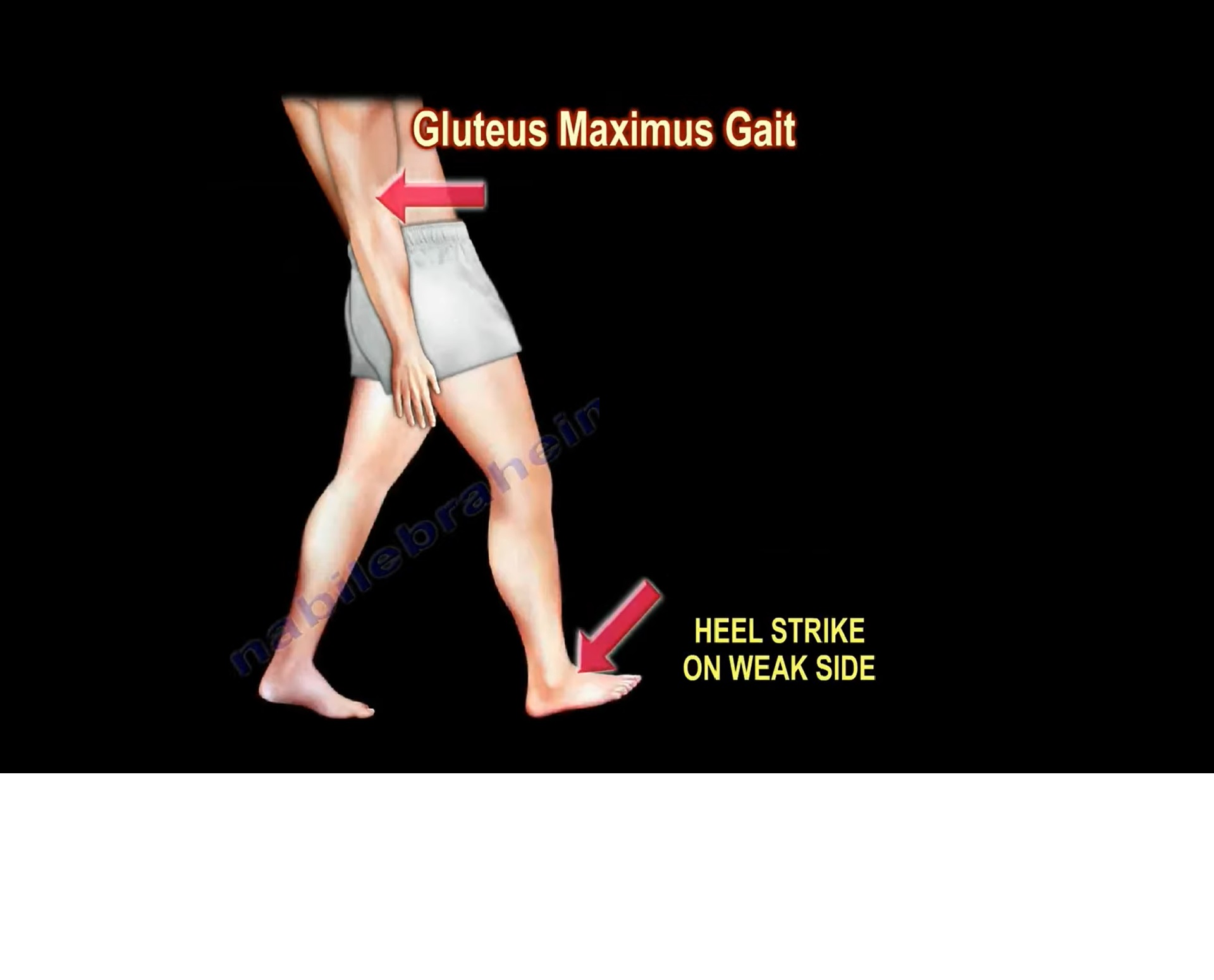 <p>at initial contact, thorax is posteriorly to maintain hip extension during stance phase often causing lurching of trunk (cause: weakness or paralysis of gluteus maximus muscle)</p>