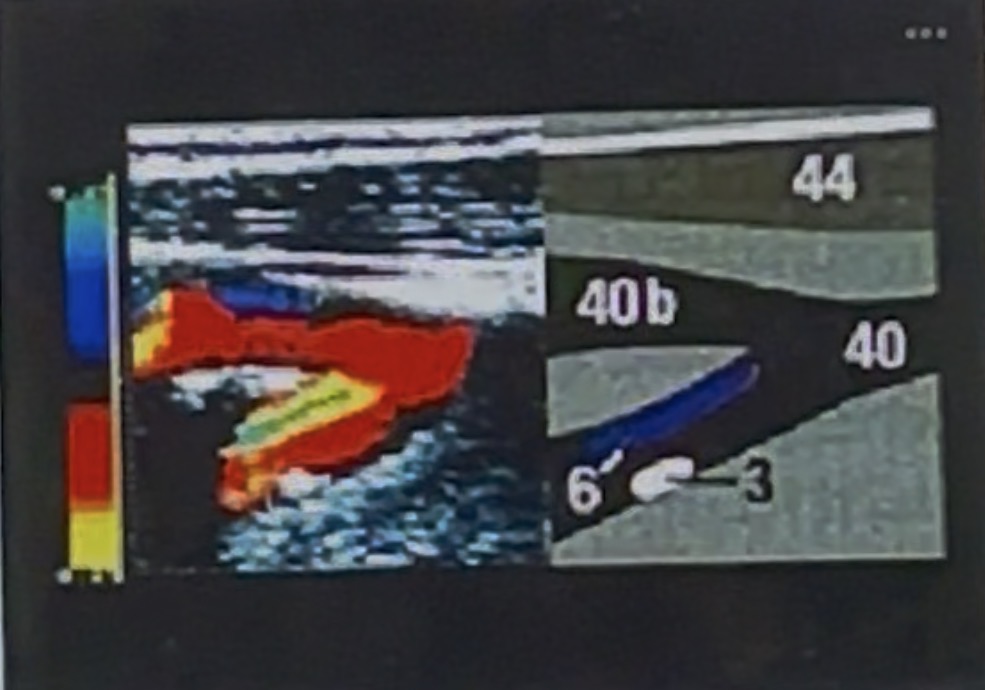 <p><span>This is a longitudinal color flow image from an earlier version of your textbook of the carotid bifurcation In the associated line drawing, #40 is the CCA and # 40b is the ECA. #3 is an area of plaque in the ICA. What is #6 pointing to?</span></p>