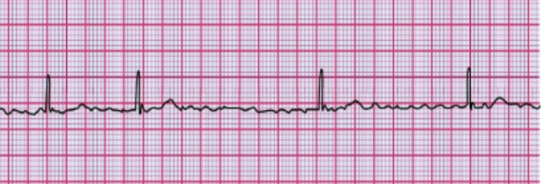 <p>What does this EKG indicate? </p>