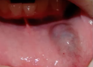 <p>LOWER lip lesion in CHILDREN due to TRAUMA </p>