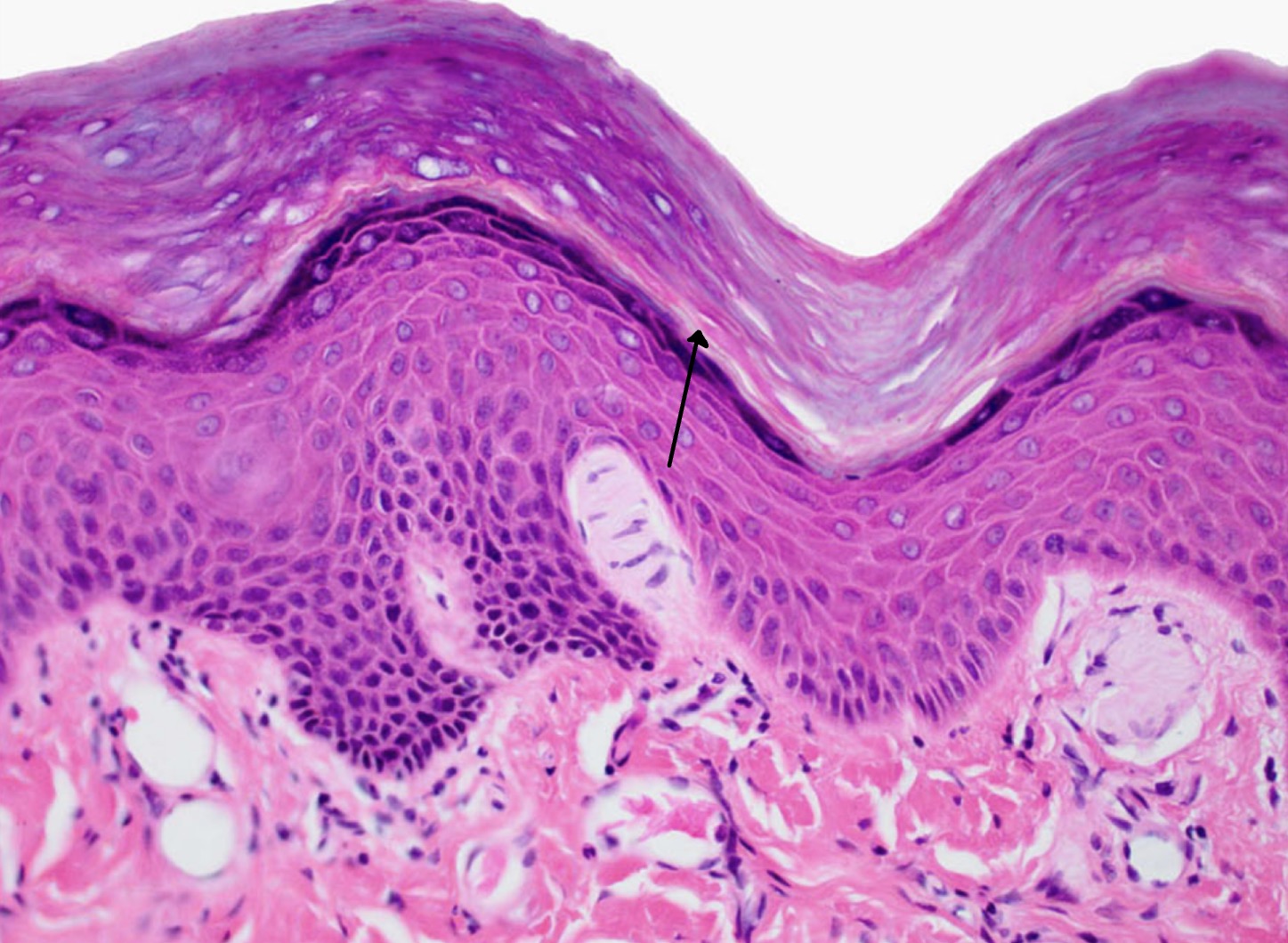 <p>Glassy strip directly above the granulosum layer. No separate nuclei or organelles, almost opaque looking, homogenous layer. Absent in thin skin. </p>