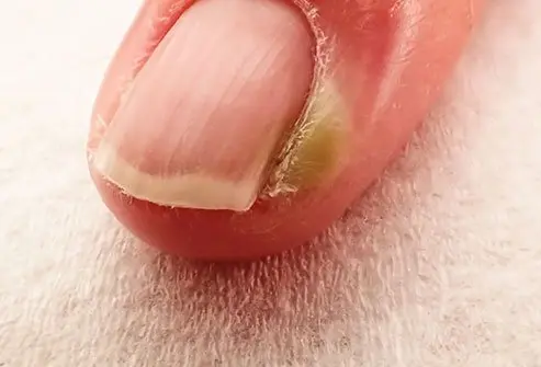 <p>what nail disease is this?</p>