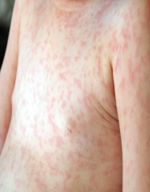 <p>Roseola Infantum (exanthem subitum) cause*</p>
