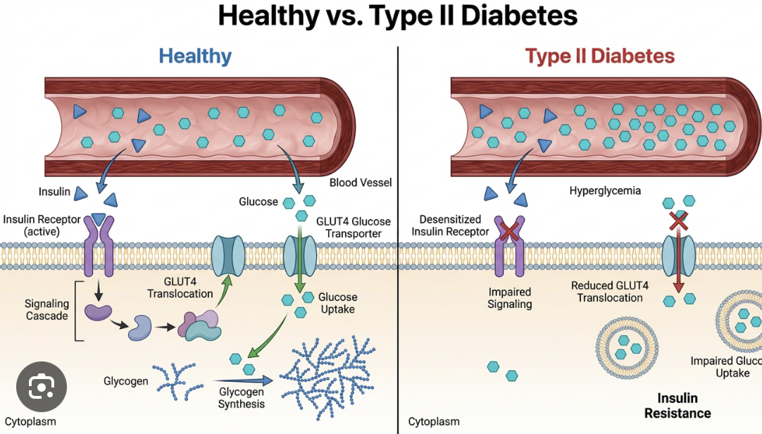 <p>Type II diabetes is a disease that affects the way the body metabolizes glucose. The body resists the effects of insulin, or doesn’t produce enough insulin.</p>