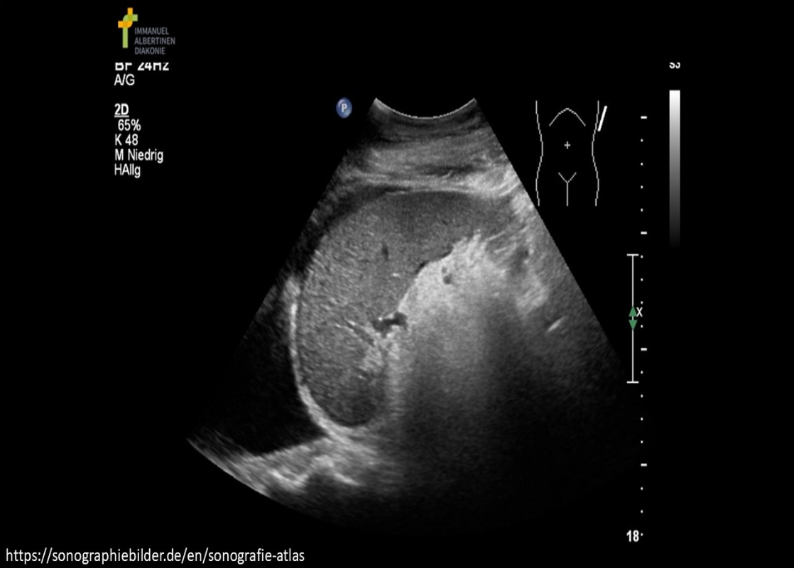 <p>The image demonstrates a coronal view of the left upper quadrant. Where is free fluid documented on the image?</p><p>A. subhepatic space and pleural space</p><p class="p1">B. subphrenic space and pleural space</p><p class="p1">C. subphrenic space and splenorenal space</p><p class="p1">D. subphrenic space and paracolic gutter</p>