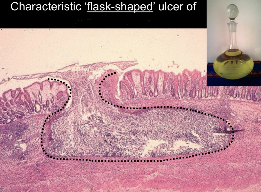 <p>Flask Shaped Ulcer</p>