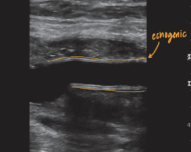 <p>double line appearance of graft wall</p>