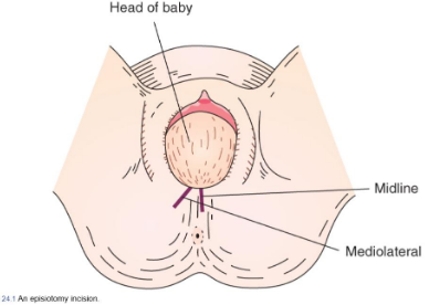 <p><span style="line-height: 20px;"><span>Surgical incision of perineum to release pressure on the fetal head with birth and possibly shorten the last portion of the second stage of labor&nbsp;</span></span></p><ul><li><p class="Paragraph SCXW55738605 BCX2" style="text-align: left;"><span style="line-height: 20px;"><span>Not done midline so it doesn’t split through anus. Mediolaterally&nbsp;</span></span></p></li></ul><p></p>