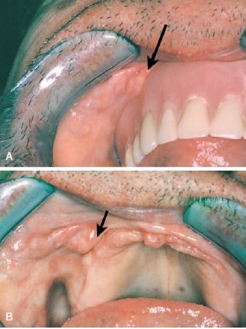 <p>This is a fibrous hyperplasia but what is it induced by?</p>