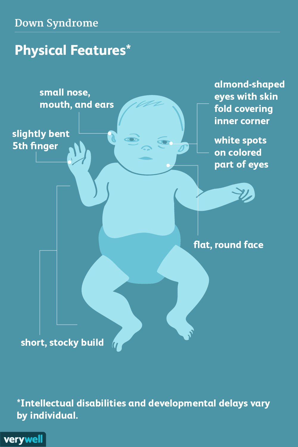 <p>A genetic disorder caused by the presence of an extra chromosome 21, leading to physical and intellectual disabilities. <span style="font-family: Aptos, sans-serif; line-height: 115%;">DS can affect general cognitive development as well as language development.</span></p>
