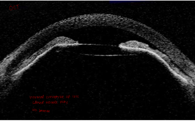 <p>normal curvature of the iris </p><p>angle closed the whole way (periphery and central)</p><p>no iris bombe </p>