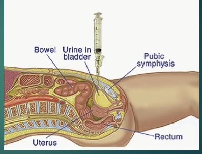 <ol><li><p><span style="color: rgb(160, 59, 237);"><strong>clean catch</strong> </span><span style="color: rgb(22, 19, 24);">method/ or take from </span><span style="color: rgb(160, 59, 237);"><strong>catheter</strong></span></p></li></ol><ul><li><p>collect <strong>midstream urine</strong></p></li></ul><ol start="2"><li><p>collect first <span style="color: rgb(19, 162, 85);"><strong>morning urine</strong></span></p></li><li><p>help w/ <span style="color: rgb(156, 136, 35);"><strong>suprapubic aspiration</strong></span> if needed</p></li></ol><p></p>