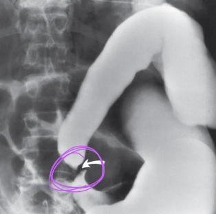 <p>Twisting of a loop of intestine, which creates and obstruction</p><ul><li><p>Bird’s beak appearance</p></li><li><p>Common sites: Cecum and Sigmoid</p></li><li><p>Ischemia and necrosis is a concern</p></li></ul><p></p>