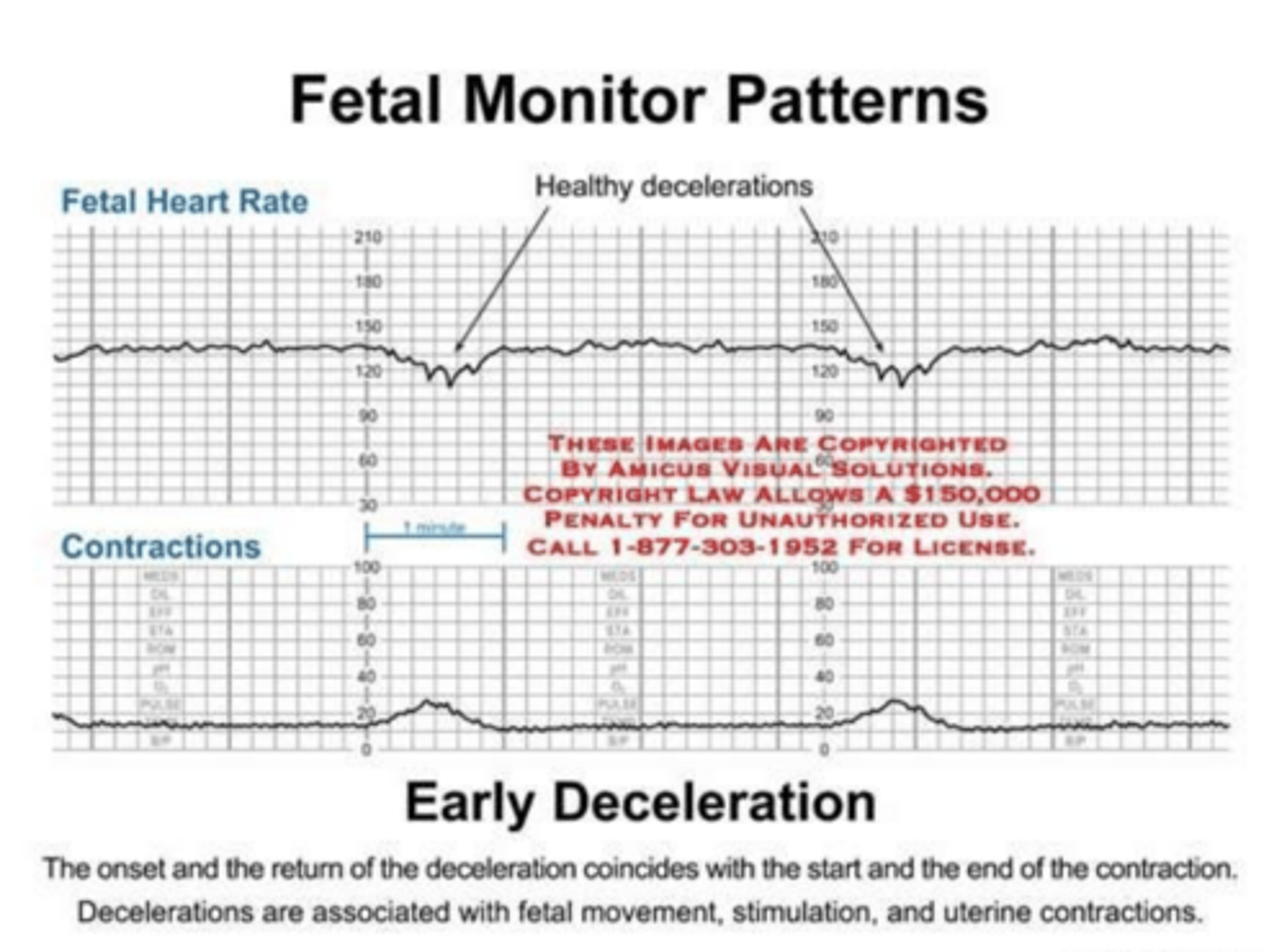 <p>Mirror contractions seen with head compression</p>