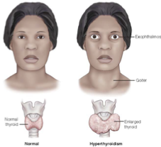 <p><mark data-color="yellow" style="background-color: yellow; color: inherit;">Accelerated metabolism and overstim. of SNS</mark></p><ul><li><p>usually caused by <span style="color: red;">Grave’s</span></p></li></ul><p><strong><mark data-color="blue" style="background-color: blue; color: inherit;">Signs: </mark></strong>everything is increased</p><ul><li><p>elevated HR, heat intolerance, gastric activity (BM/D), increased app, weight loss, <span style="color: red;">exophthalmos &amp; goiter</span></p></li></ul><p><strong><mark data-color="red" style="background-color: red; color: inherit;">Diagnostic:</mark></strong> <span style="color: blue;">high T3 &amp; T4, low TSH</span></p><p></p>