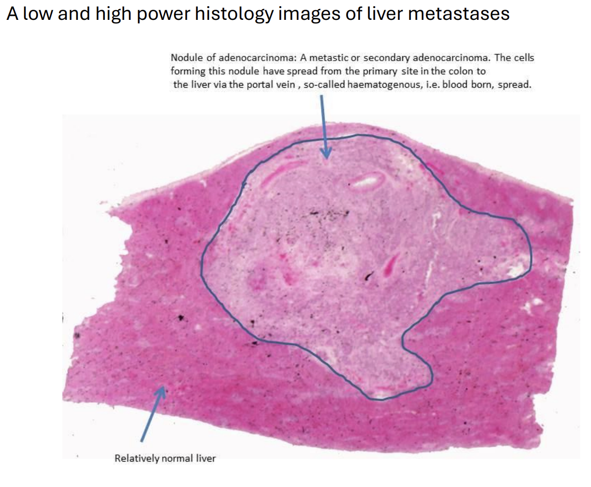 <p>generally the spread or metastasis of cancer to other organs that causes illness and death. For example, spread to the liver, lung, brain or bone can prevent them from performing their normal functions. </p>