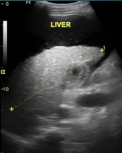 <p>a diffuse process destroys the normal architecture of the liver lobules following inflammation</p><p>most common causes are hepatitis and other viruses, and alcohol abuse</p><p>Increased risk for HCC – Hepatocellular carcinoma</p><p>Symptoms fatigue, weakness, weight loss, nausea, and itchy skin</p><p>presents with jaundice (yellow skin/eyes), severe abdominal swelling</p>