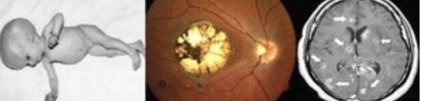 <p>toxo congênita: coriorretinite, hidrocefalia, calcificações intracranianas difusas</p><p>esquema tríplice 1 ano </p><p>corticoide se proteinorraquia >1g ou coriorretinite grave</p>