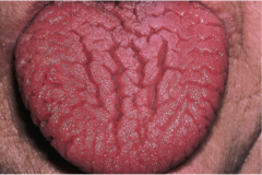 <p>a cleft/groove with prominent depth</p>