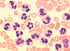 <p>What does this blood smear diagnose?</p>