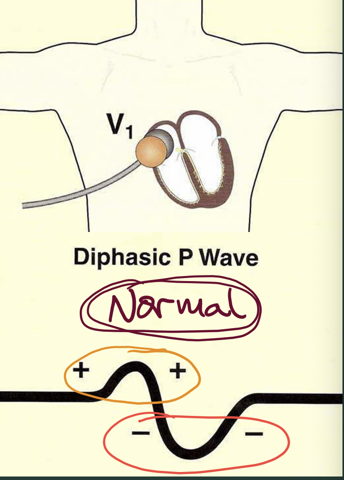 <p>small biphasic; RA-initial (+) then LA-terminal (-) component</p>
